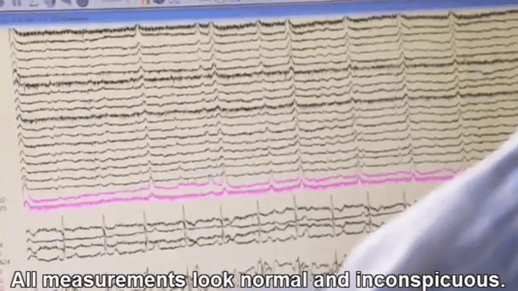 Normal EEG